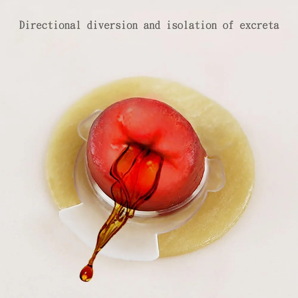 20PCS Upgraded Skin Barrier Ring with Directional Flow Ostomy Supplies Customizable Skin Barrer Ring 2mm